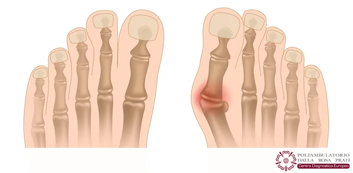 Alluce Valgo: cosa è, da cosa è causato e come curarlo