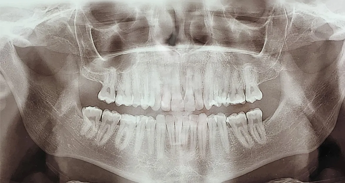 Ortopantomografia e TAC Dentalscan per una indagine dentale completa