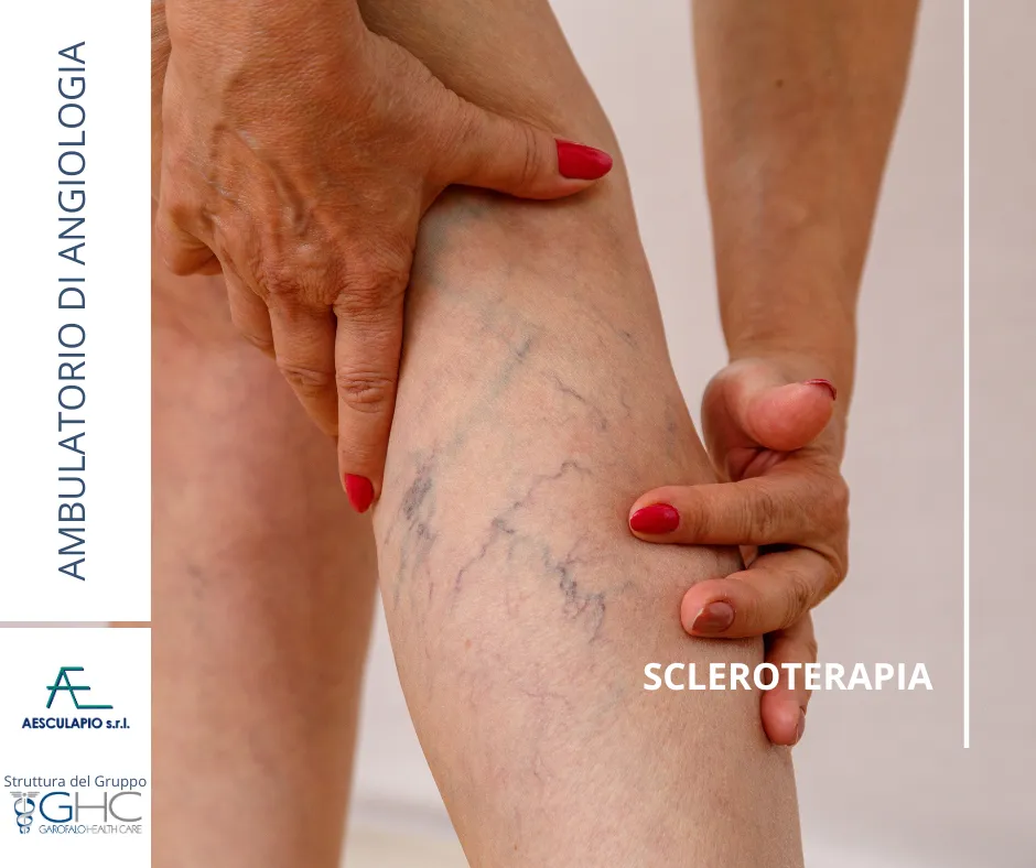 Scleroterapia: soluzioni eccellenti per problemi vascolari 